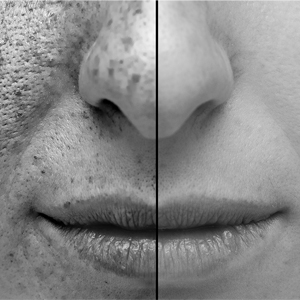 face divided in half with damaged skin on one side and clear skin on the other