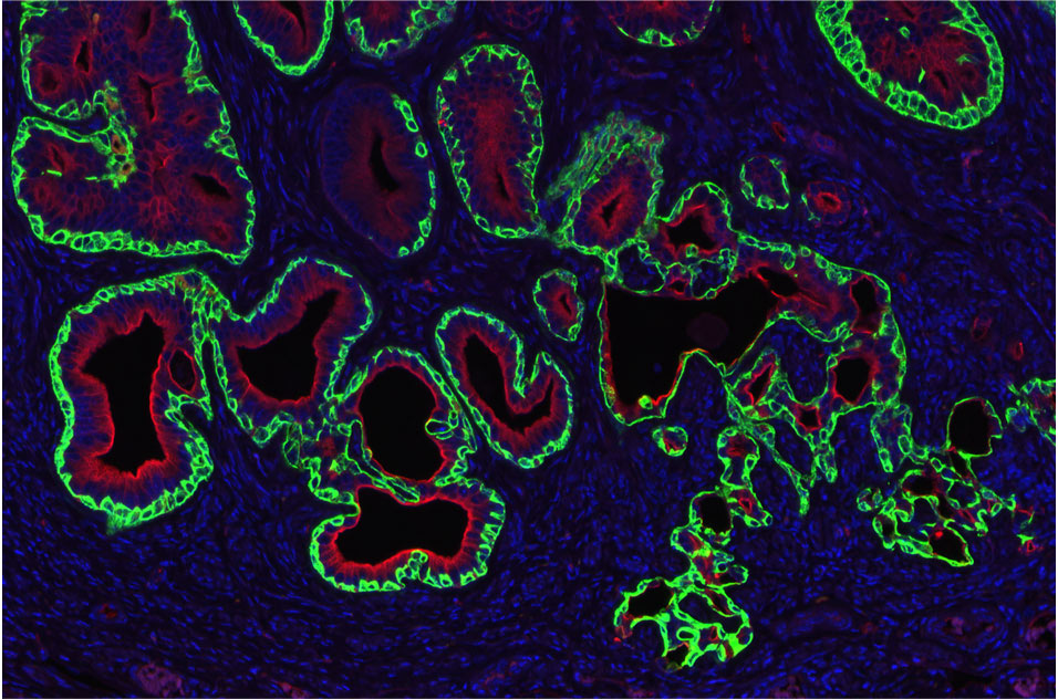 endometrial carcinoma in an adult mouse