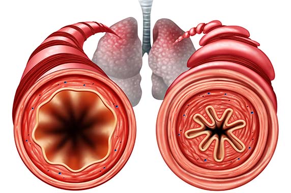 Graphic of what happens in the lungs during an asthma attack
