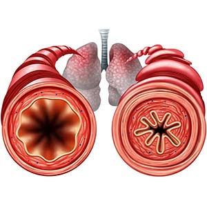 Graphic of what happens in the lungs during an asthma attack