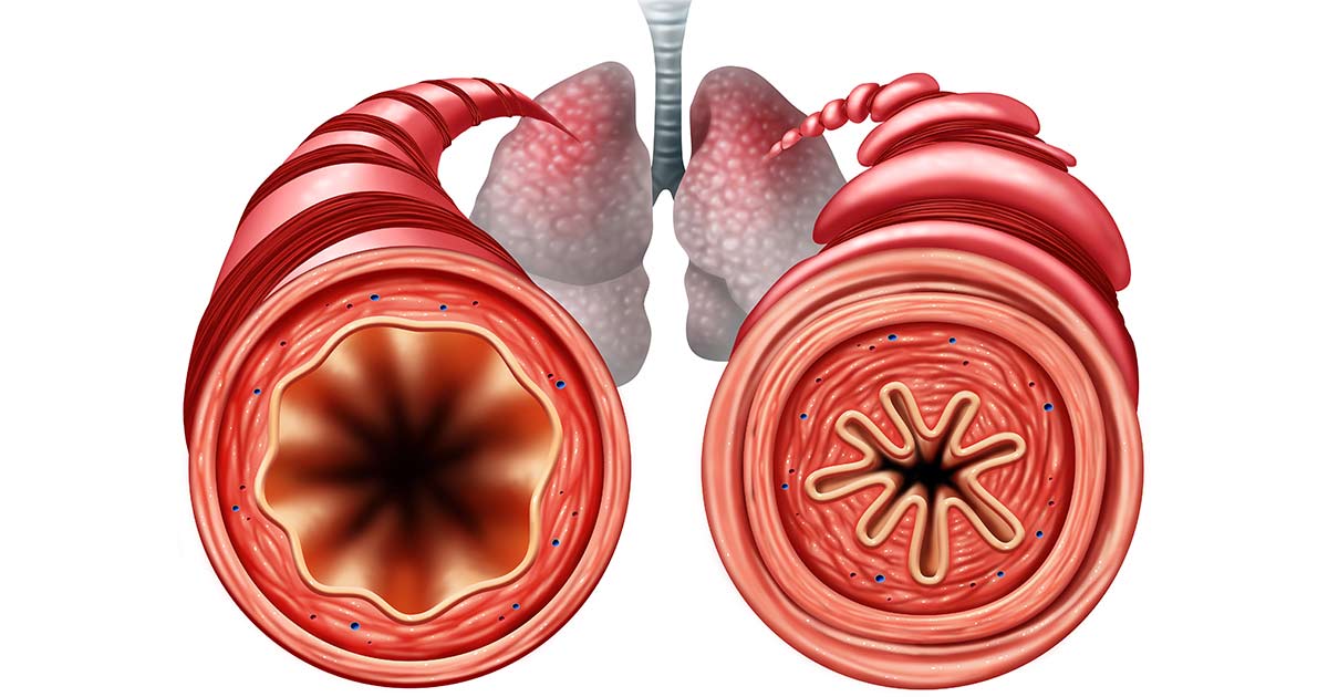 open vs. constricted airway in human lung