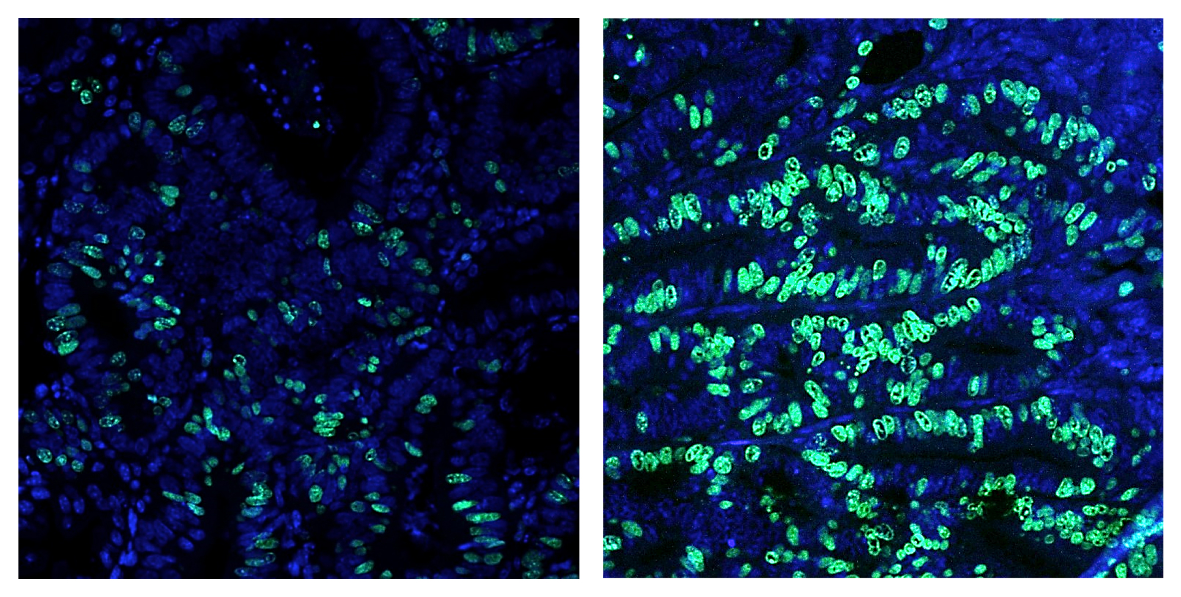 Colon cancer growth, as measured by the number of dividing cells 