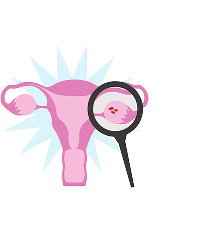 Uterus ovaries pcos magnifying glass in illustration