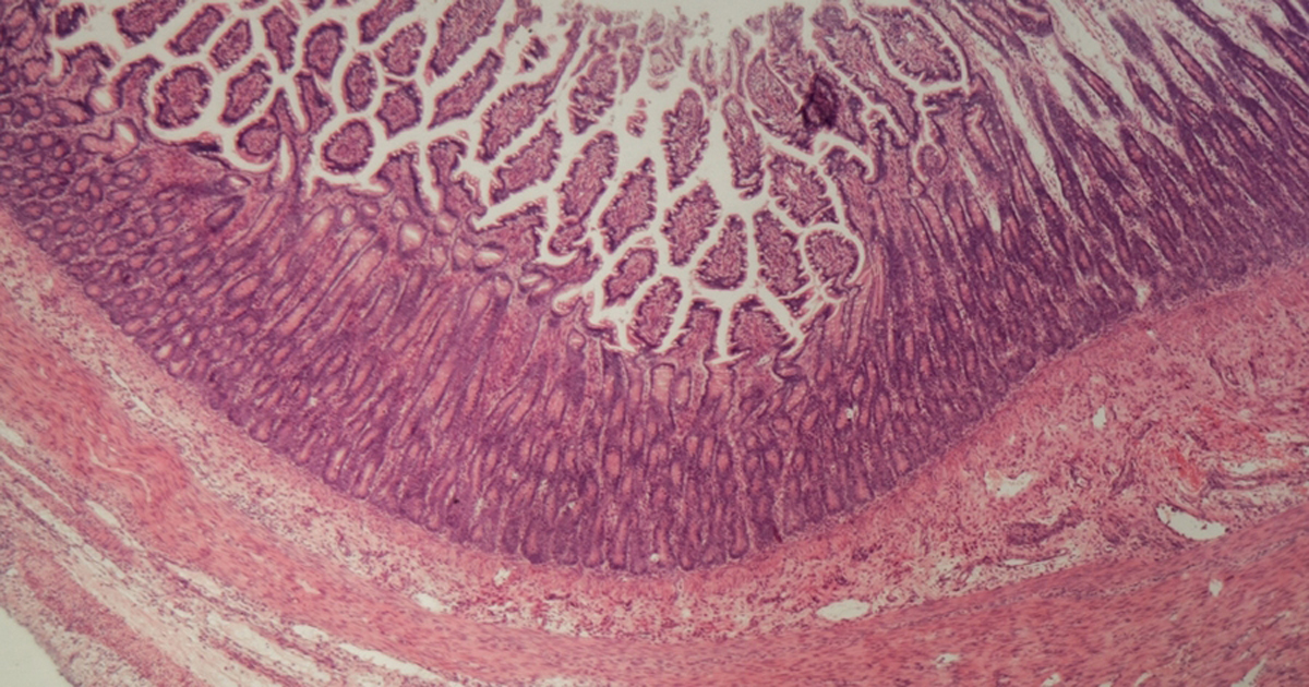 ulcerative colitis tissue