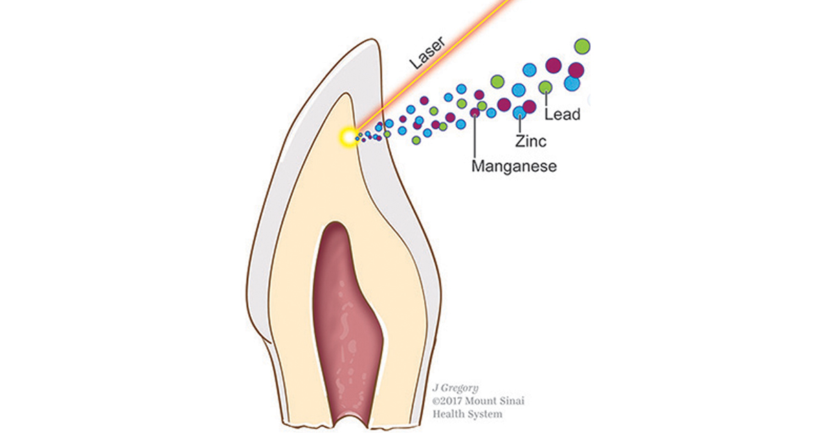 baby tooth showing manganese, zinc and lead exposure