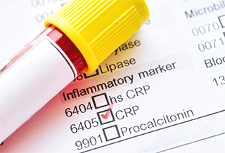 Blood sample with laboratory requisition form for C-reactive protein (CRP) test