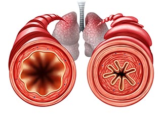 health and unhealthy bronchial tube