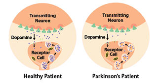 Parkinson's patients have less dopamine