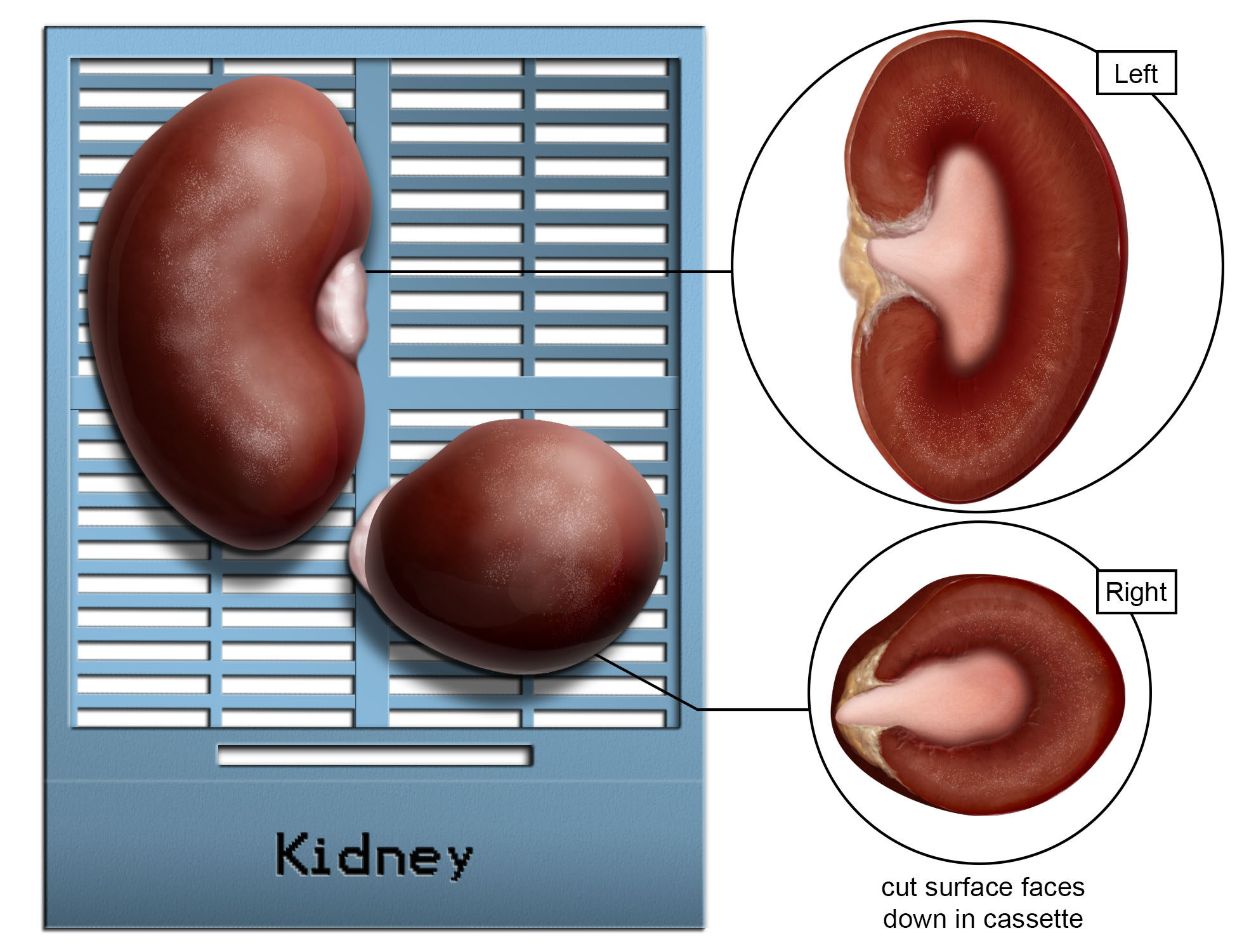 Kidney thumb