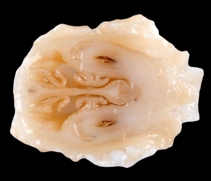 L1 posterior nasal cavity section