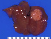 hepatocellular adenoma