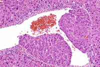 Intravascular hepatocytes
