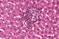 large areas of fatty change liver