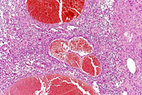 hemangiosarcoma