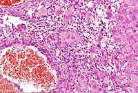 hemangiosarcoma