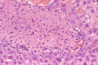 example of focal necrosis