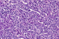 oval cell hyperplasia