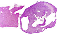 hepatocholangiocarcinoma