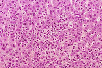 Mast cell tumor