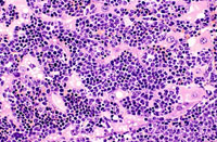 erythroleukemia