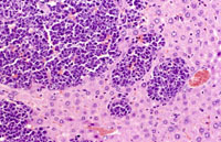 erythroleukemia