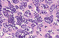 erythroleukemia