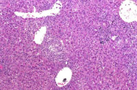 Histiocytic Sarcoma