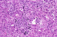 Histiocytic Sarcoma