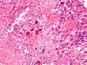 periportal fatty change in liver