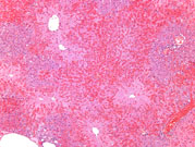 an example of centrilobular hepatocellular necrosis with associated hemorrhage sometimes referred to as hemorrhagic necrosis