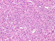 A higher magnification showing proliferation of oval cells with formation of glandular structures resembling bile ducts