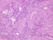marked oval cell proliferation is showing bridging between adjacent portal areas