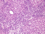 example of marked oval cell proliferation is showing bridging between adjacent portal areas