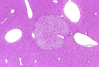 hepatocellular adenoma