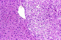 hepatocellular adenoma