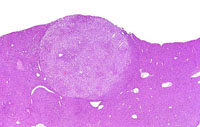 hepatocellular adenoma