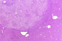 hepatocellular adenoma