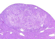 hepatocellular adenoma