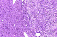 hepatocellular adenoma