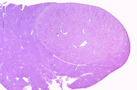 eosinophilic adenoma