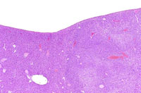 basophilic adenoma