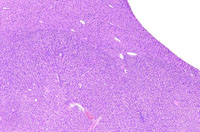 basophilic adenoma