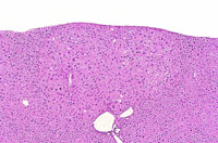 eosinophilic adenoma