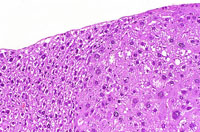 eosinophilic adenoma