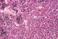 Hepatocellular Carcinoma