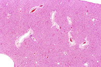 amyloid deposition in mouse liver