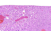 angiectasis low magnification