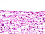 bile duct cyst