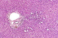 Bile Duct Hyperplasia