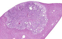 cholangiocarcinoma